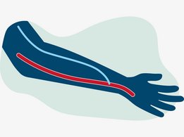 arterial-venous fistula